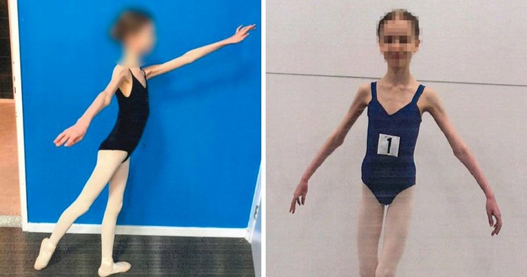 PHOTO: A couple in Australia for years starved daughter ballerina; She had 27 pounds at 17