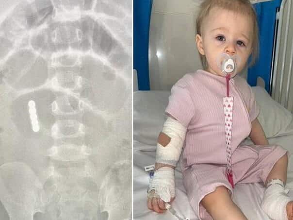 Baby swallowed six magnets, saved after a heavy surgery