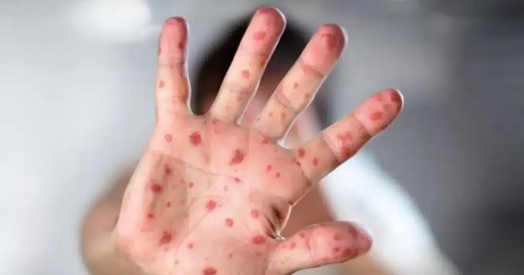 ZDK: Interrupted Morbil’s epidemic