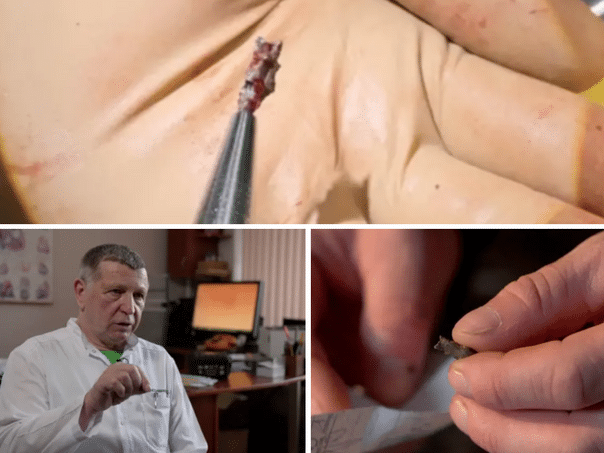 "They took out my heartless shrapnel" – Magnets that save lives in Ukraine