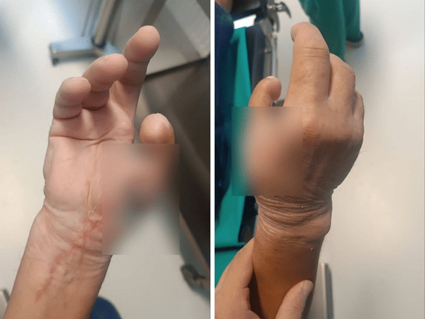 The UKC team has transplanted the patient finger feet on a handful