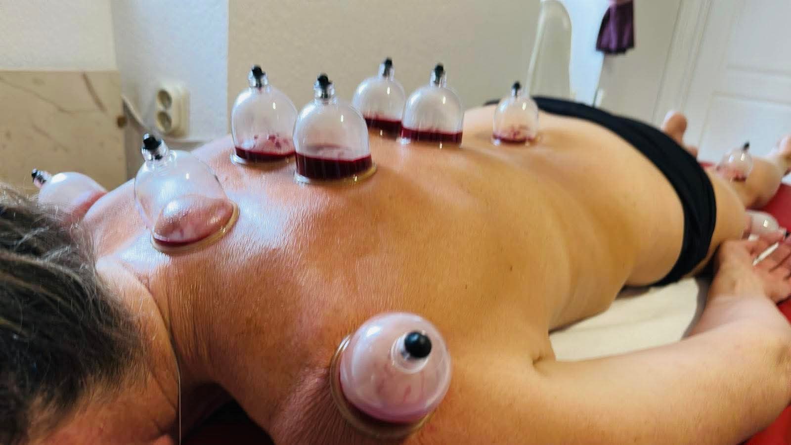 hijama